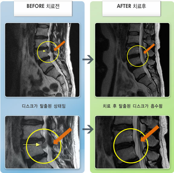 자생한방병원 치료사례 MRI로 보는 치료결과-허리 가운데 통증 및 우측 대퇴 저림감