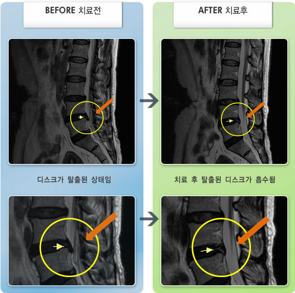 자생한방병원 치료사례 MRI로 보는 치료결과-허리 통증과 다리 저림 증상