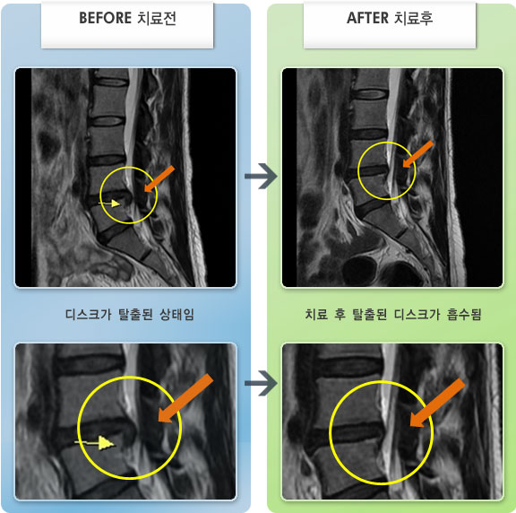 자생한방병원 치료사례 MRI로 보는 치료결과-허리디스크로 인한 허리 통증 및 야간통