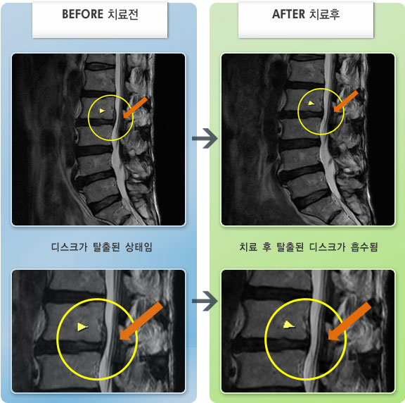 자생한방병원 치료사례 MRI로 보는 치료결과-허리디스크로 인한 좌측 족관절 외측 부위 통증