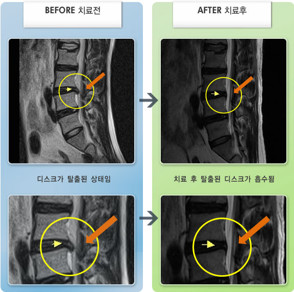 자생한방병원 치료사례 MRI로 보는 치료결과-허리 뻐근한 통증과 우측 대퇴로 무력감이 있었다.