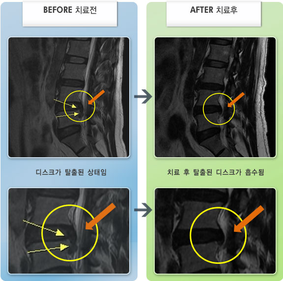 자생한방병원 치료사례 MRI로 보는 치료결과-허리와 왼쪽 엉덩이에서 다리 통증이 있었다.