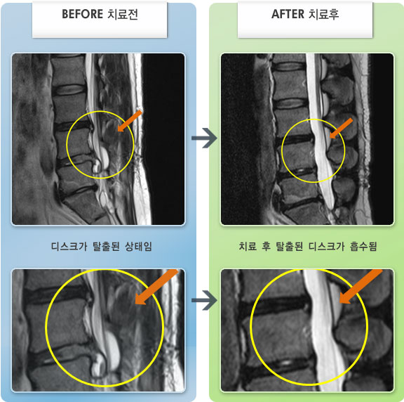 자생한방병원 치료사례 MRI로 보는 치료결과-2개월 전 수술을 받았으나 재발하였다.