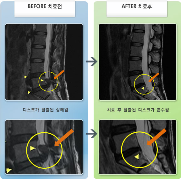자생한방병원 치료사례 MRI로 보는 치료결과-허리디스크로 인한 허리 및 좌측 골반 통증