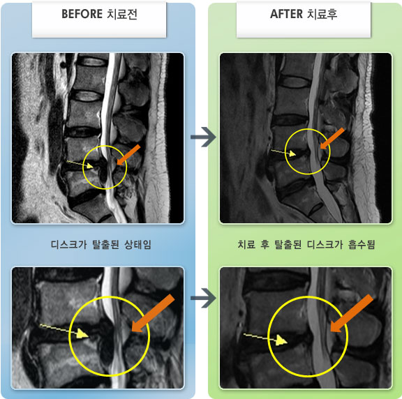 자생한방병원 치료사례 MRI로 보는 치료결과-허리 통증과 왼쪽 엉덩이, 다리 당기는 통증
