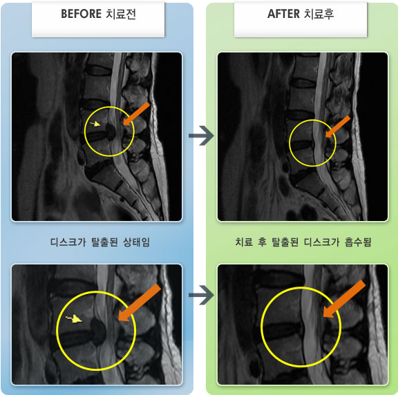 자생한방병원 치료사례 MRI로 보는 치료결과-허리와 간헐적 오른쪽 다리 통증