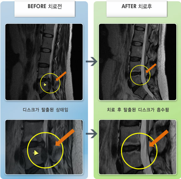 자생한방병원 치료사례 MRI로 보는 치료결과-허리디스크로 인한 다리 저림 증상