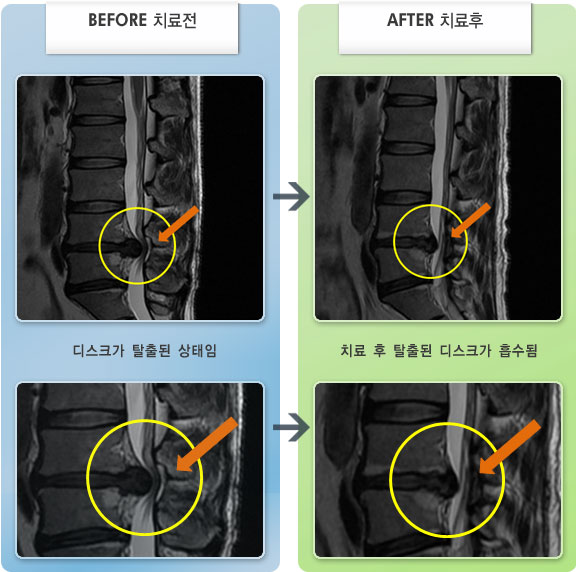 자생한방병원 치료사례 MRI로 보는 치료결과-허리와 양쪽 엉덩이 통증 및 우측 종아리 뒤쪽 통증