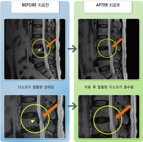 자생한방병원 치료사례 MRI로 보는 치료결과-오른쪽 허리가 아프고 오른쪽 허벅지, 종아리 바깥쪽으로 당기고 저리고 감각이 무뎠다.
