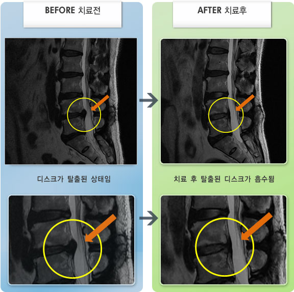 자생한방병원 치료사례 MRI로 보는 치료결과-간헐적 우측 발바닥 저림 증상
