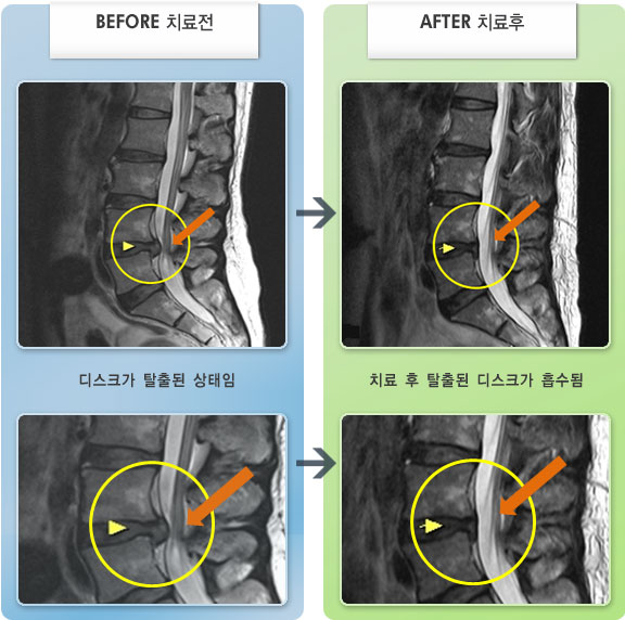 자생한방병원 치료사례 MRI로 보는 치료결과-허리와 양쪽 엉덩이에서 다리 통증