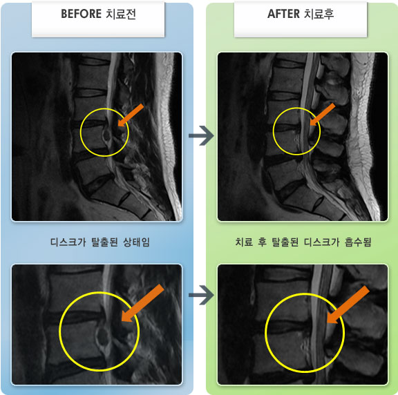 자생한방병원 치료사례 MRI로 보는 치료결과-허리 통증과 오른쪽 다리 당김 증상