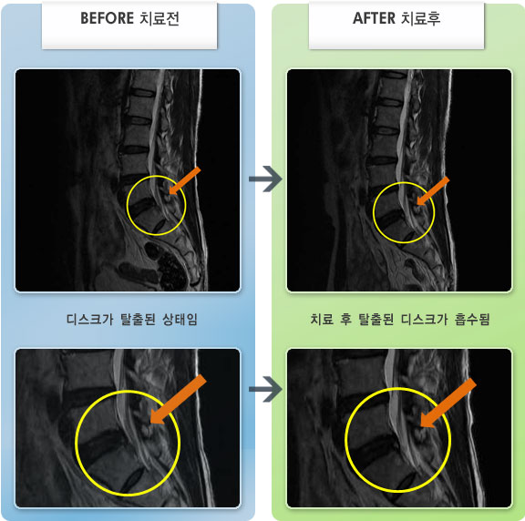자생한방병원 치료사례 MRI로 보는 치료결과-우측 엉치 및 발끝 통증