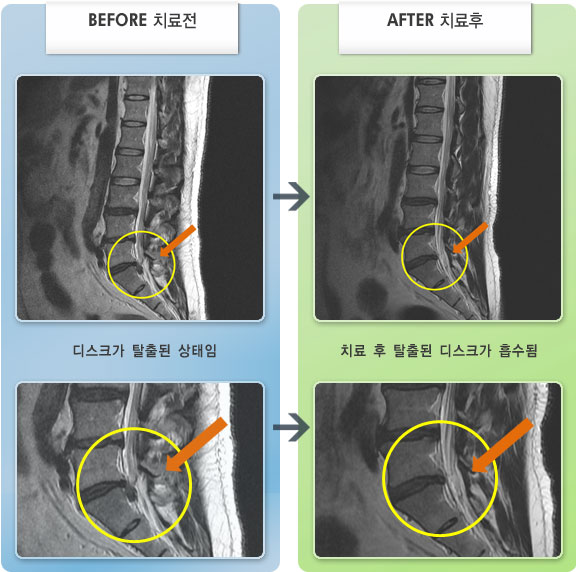 자생한방병원 치료사례 MRI로 보는 치료결과-왼쪽 다리 뒤쪽 통증