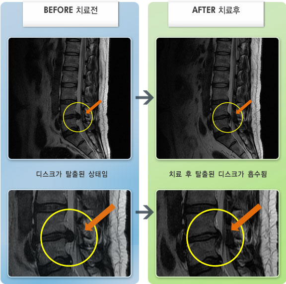 자생한방병원 치료사례 MRI로 보는 치료결과-허리 통증과 보행시 불편감