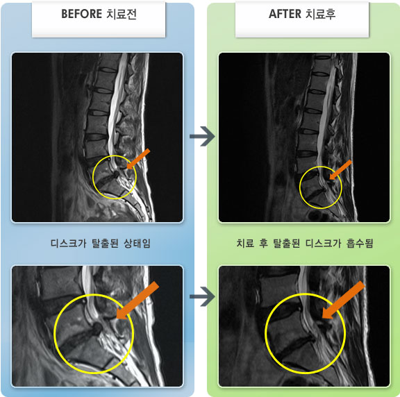 자생한방병원 치료사례 MRI로 보는 치료결과-오른쪽 허리 통증과 오른쪽 다리 통증 및 저림 증상