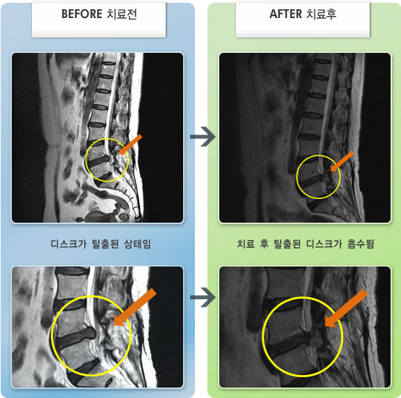 자생한방병원 치료사례 MRI로 보는 치료결과-왼쪽 둔부 통증 및 하지 통증