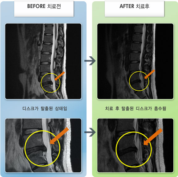 자생한방병원 치료사례 MRI로 보는 치료결과-왼쪽 허리, 엉치 통증