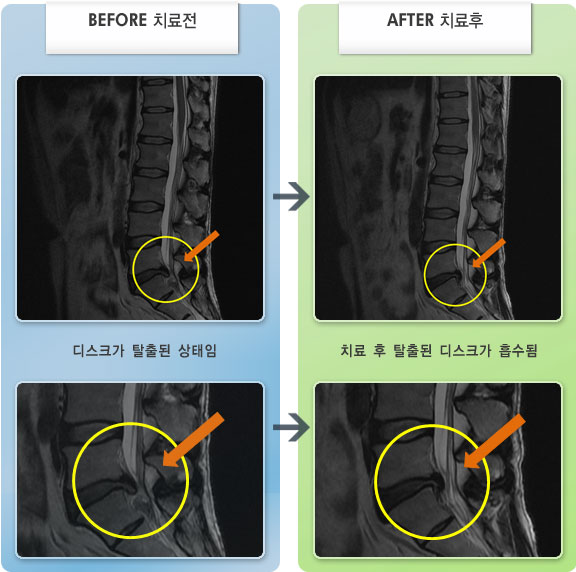 자생한방병원 치료사례 MRI로 보는 치료결과-좌측 요통 및 엉치 통증과 발목, 발까지 저림이 있음