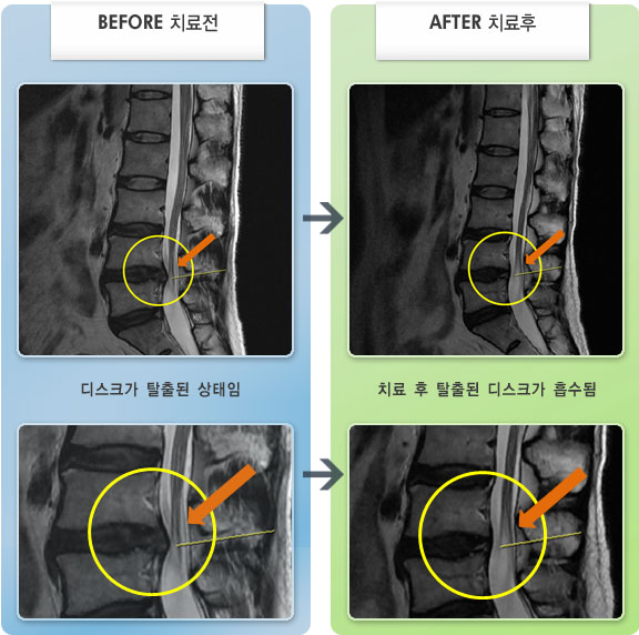자생한방병원 치료사례 MRI로 보는 치료결과-왼쪽 허리 통증