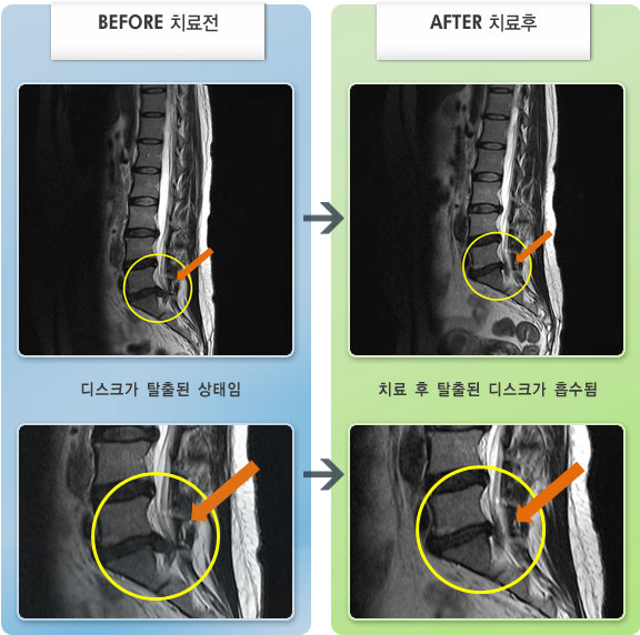 자생한방병원 치료사례 MRI로 보는 치료결과-운전시, 좌위시 결리는 통증이 있고 보행시에도 통증