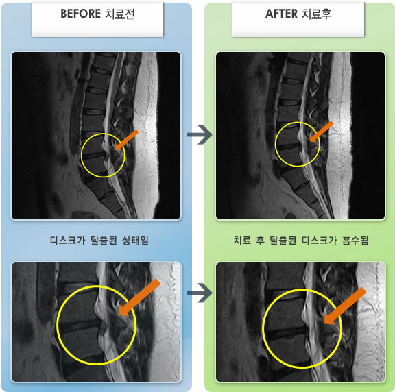자생한방병원 치료사례 MRI로 보는 치료결과-양쪽 허벅지 뒤쪽 통증과 가끔 종아리까지 내려오는 통증