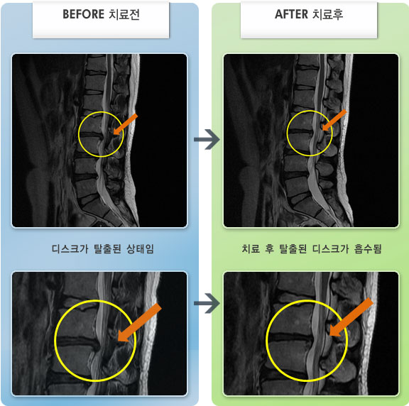 자생한방병원 치료사례 MRI로 보는 치료결과-아침 기상시 장시간 기립시 자세변경시 통증이 증가