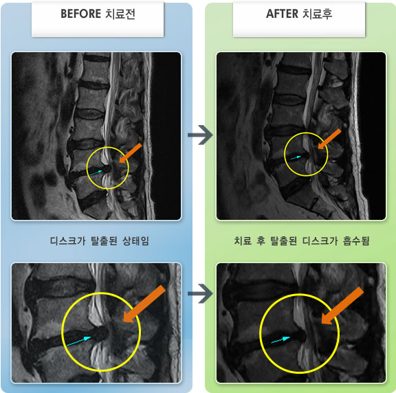 자생한방병원 치료사례 MRI로 보는 치료결과-허리 통증과 간헐적으로 양쪽 허벅지, 종아리 저림