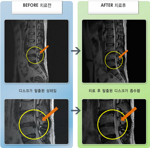 자생한방병원 치료사례 MRI로 보는 치료결과-어떤 자세에서도 통증, 보행시 통증으로 절뚝거리고 다리에 힘이 없음