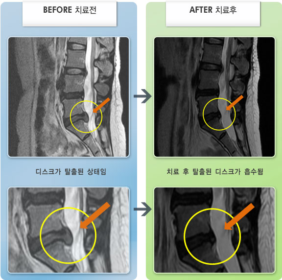자생한방병원 치료사례 MRI로 보는 치료결과-허리와 왼쪽 엉치에서 허벅지 종아리 뒤쪽으로 통증