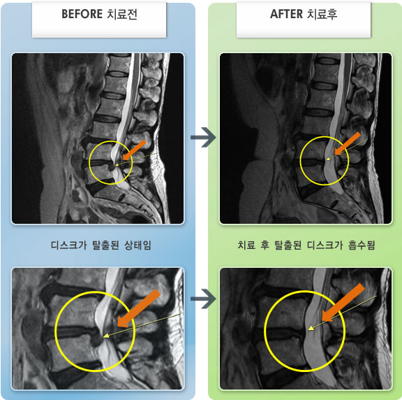 자생한방병원 치료사례 MRI로 보는 치료결과-허리와 다리 통증