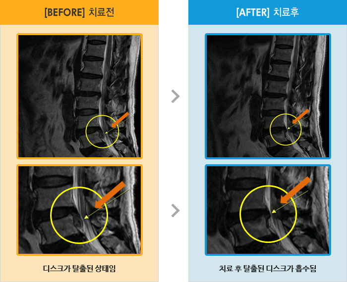 자생한방병원 치료사례 MRI로 보는 치료결과-다리 전체적으로 외측으로 저리고 쑤시는 통증