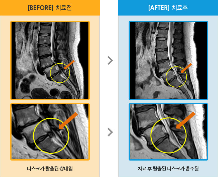자생한방병원 치료사례 MRI로 보는 치료결과-좌측 허리 통증 및 좌측 하지 비증, 통증