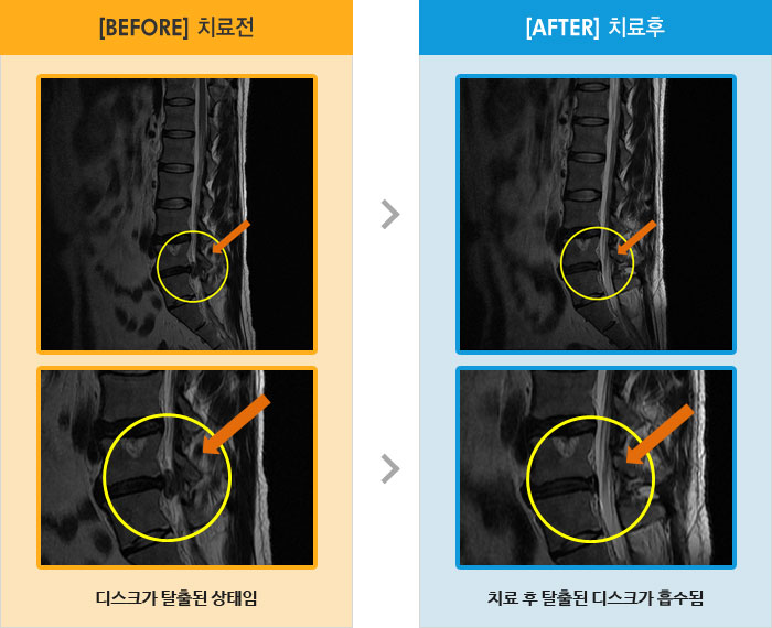 자생한방병원 치료사례 MRI로 보는 치료결과-허리와 양쪽 엉덩이 통증 및 우측 하지 후면 전체적 통증