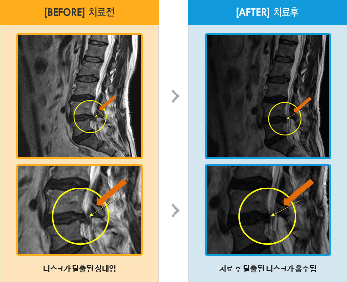 자생한방병원 치료사례 MRI로 보는 치료결과-허리 통증과 오른쪽 다리 저림 및 허벅지 뒤쪽 저림