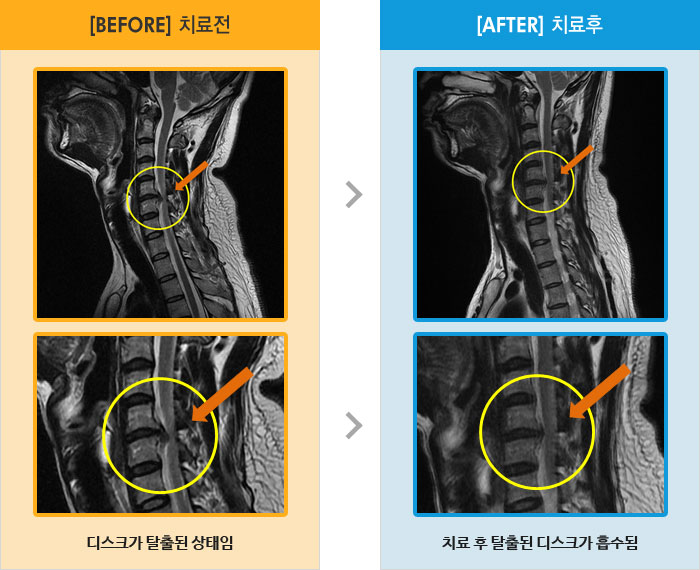 자생한방병원 치료사례 MRI로 보는 치료결과-오른쪽 어깨는 당기고,  팔은 저림