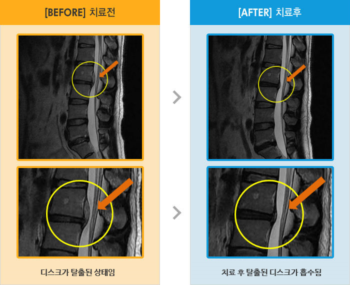 자생한방병원 치료사례 MRI로 보는 치료결과-허리 숙일 때 허리 통증