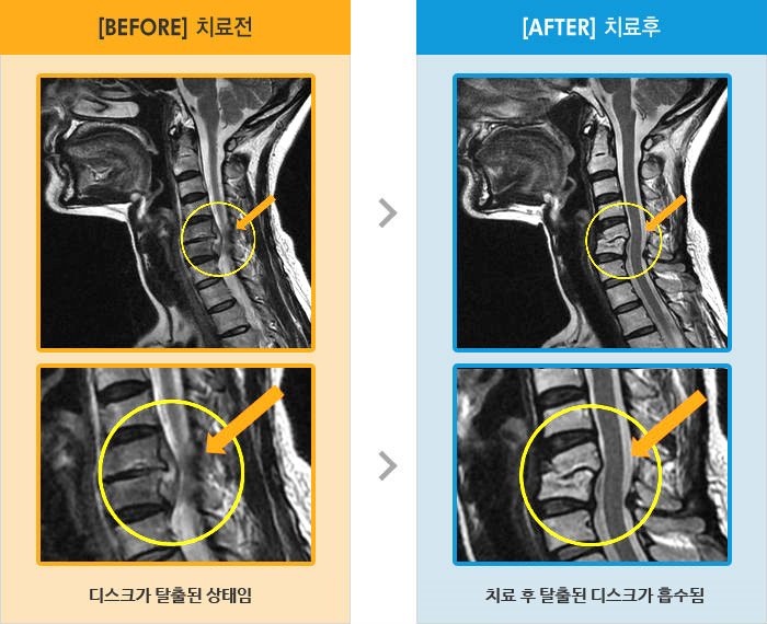 자생한방병원 치료사례 MRI로 보는 치료결과-아침이 고통스러울 정도로 목과 양쪽 어깨 통증