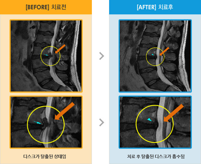 자생한방병원 치료사례 MRI로 보는 치료결과-왼쪽 허리 결림과 오른쪽 골반 및 허벅지 저리고 당기는 통증