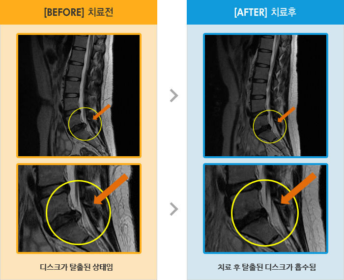 자생한방병원 치료사례 MRI로 보는 치료결과-허리 통증과 왼쪽 다리 저림