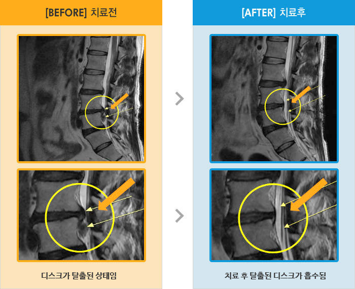 자생한방병원 치료사례 MRI로 보는 치료결과-오른쪽 다리 근력 저하 증상과 통증
