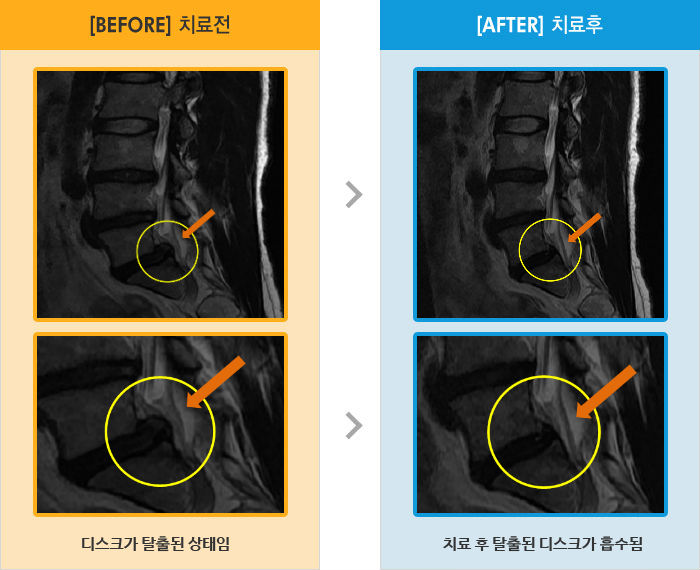 자생한방병원 치료사례 MRI로 보는 치료결과-허리 통증