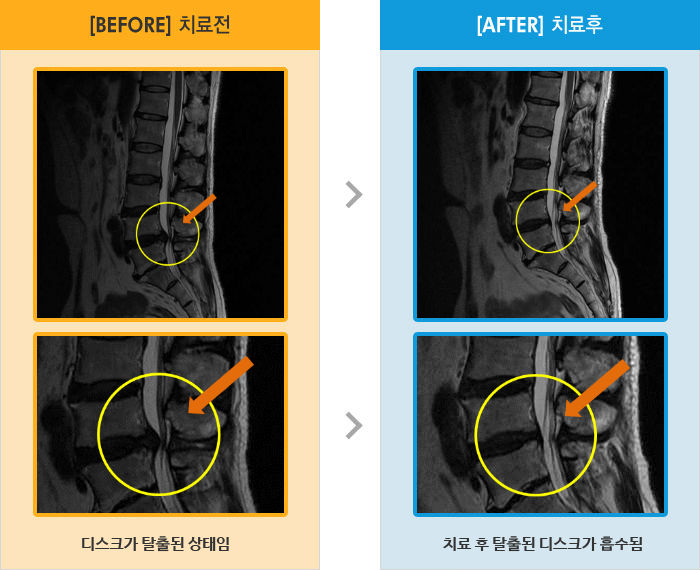 자생한방병원 치료사례 MRI로 보는 치료결과-허리와 왼쪽 다리 통증 및 저림이 있고 기상시 통증이 증가