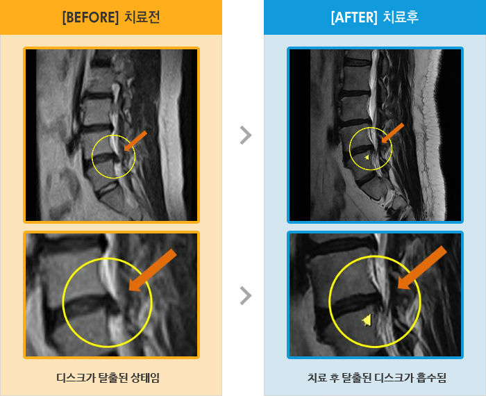 자생한방병원 치료사례 MRI로 보는 치료결과-오른쪽 엉치에서 발끝까지 통증이 밤에 잠도 못잘 정도로 증상 심함.