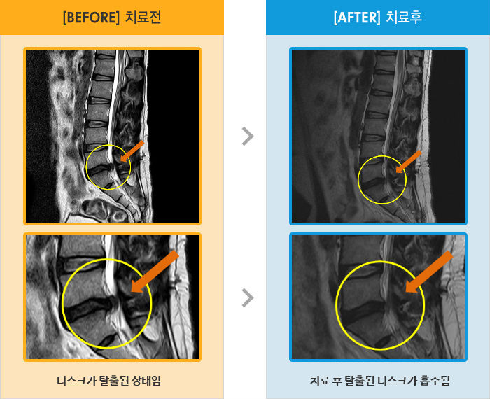 자생한방병원 치료사례 MRI로 보는 치료결과-허리와 왼쪽 허벅지 뒤로 저리고 당기는 통증