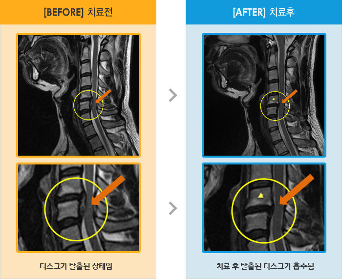 자생한방병원 치료사례 MRI로 보는 치료결과-목 통증과 고개를 움직이면 왼쪽 팔 저림 증상