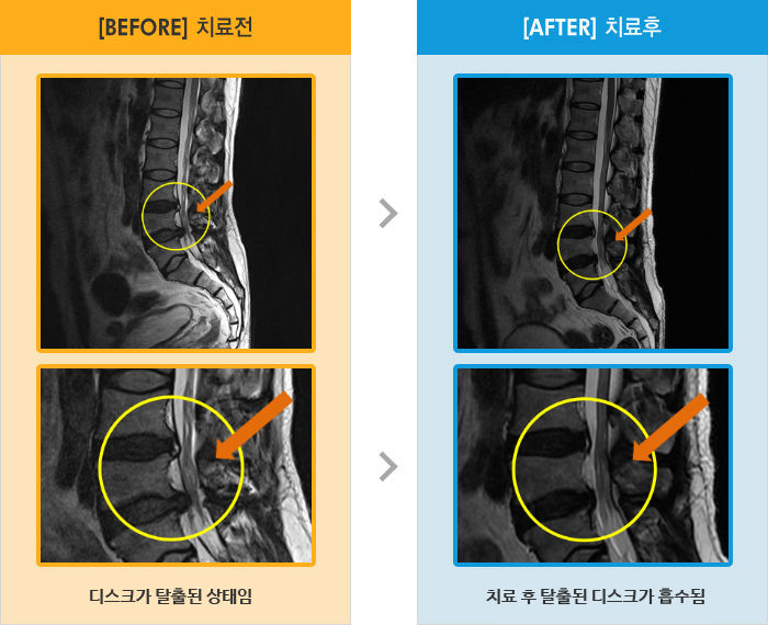 자생한방병원 치료사례 MRI로 보는 치료결과-왼쪽 엉치부터 왼쪽 다리 전체가 발바닥까지 저리고 당기는 통증