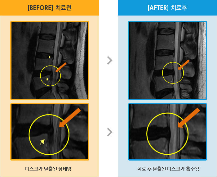 자생한방병원 치료사례 MRI로 보는 치료결과-허리 통증과 왼쪽 발끝까지 다리 저림