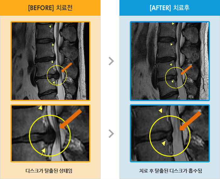 자생한방병원 치료사례 MRI로 보는 치료결과-왼쪽 허벅지에서 종아리 바깥쪽으로 저리고 통증