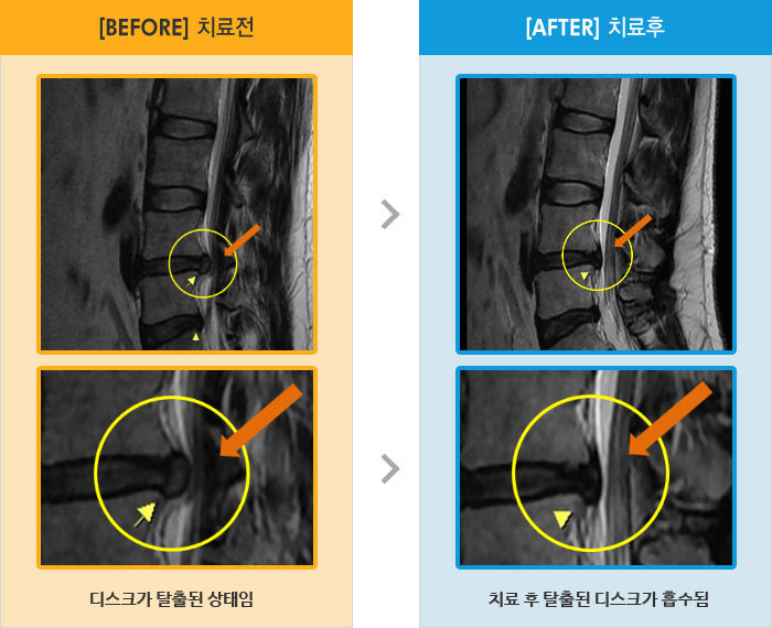 자생한방병원 치료사례 MRI로 보는 치료결과-허리 가운데와 양 옆으로 통증
